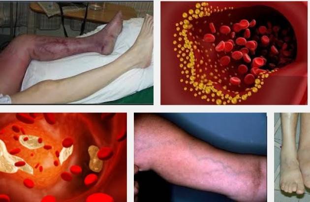 Le gambe si feriscono vene che è visibile questo per fare