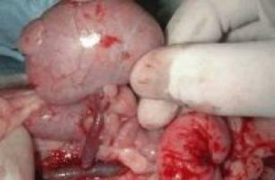 I diritto di un lavoratore che dona un rene