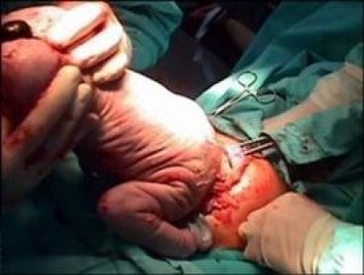 Milano. 30% di parti cesarei in meno