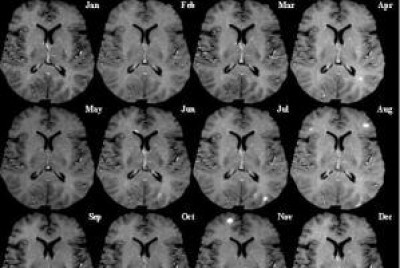 Settimama della Sclerosi Multipla