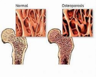 Osteoporosi: rischio di infarto miocardico con medicinale a base di stronzio