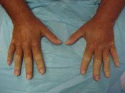 Sclerodermia, Borghetti (PD):”Riconoscerle lo status di malattia rara