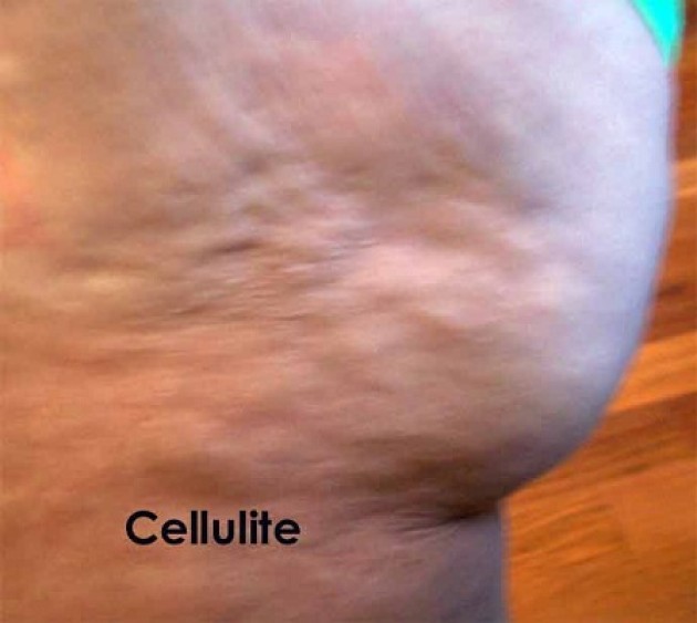 Cellulite: le creme sono efficaci?