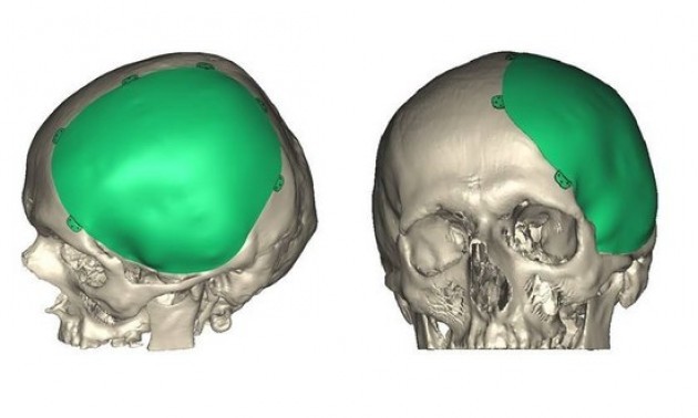 Kosice ricostruita un a porzione di cranio con una stampante 3D