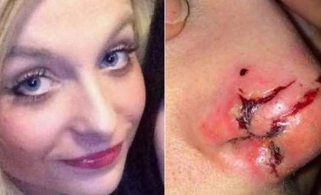 Le strappa il naso a morsi