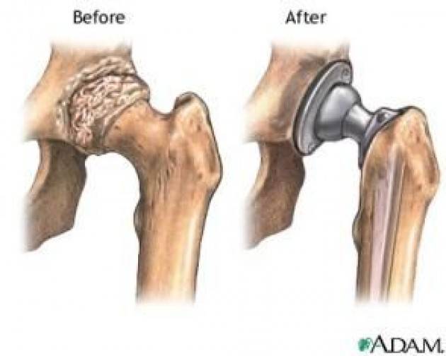 Innovazione nella chirurgia protesica di anca e di ginocchio