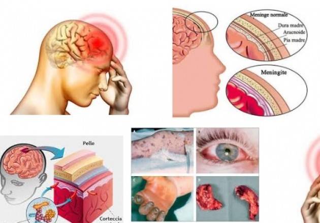 Lombardia Meningite vaccino scontato da gennaio