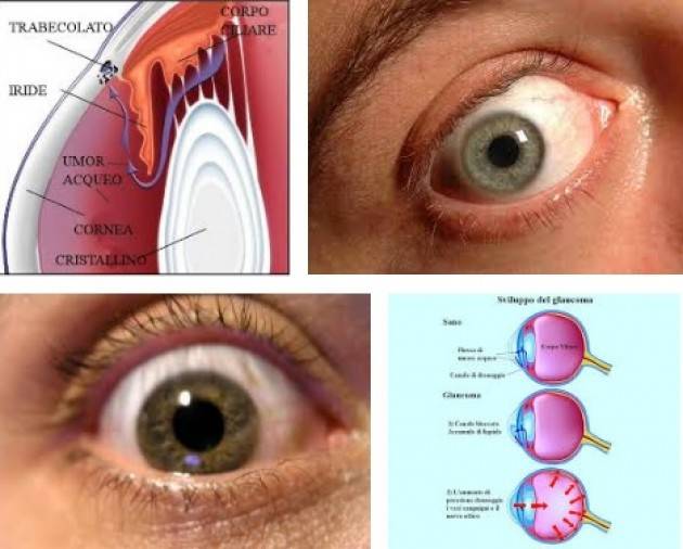 UICI Settimana Mondiale del Glaucoma Iniziative di prevenzione a Cremona ed all’Oglio PO