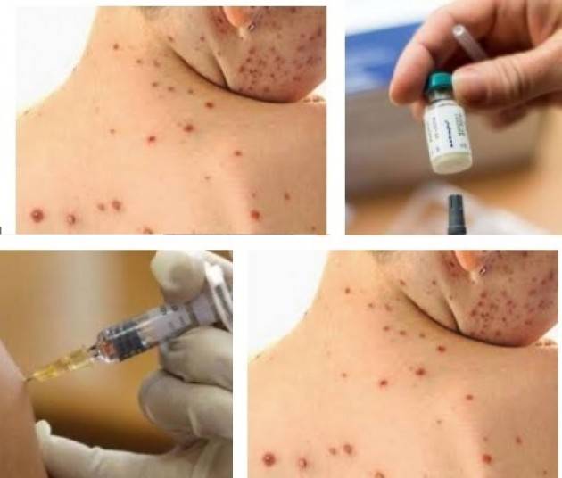 In Italia è in corso una epidemia di Morbillo  con 3.074 casi in 6 mesi