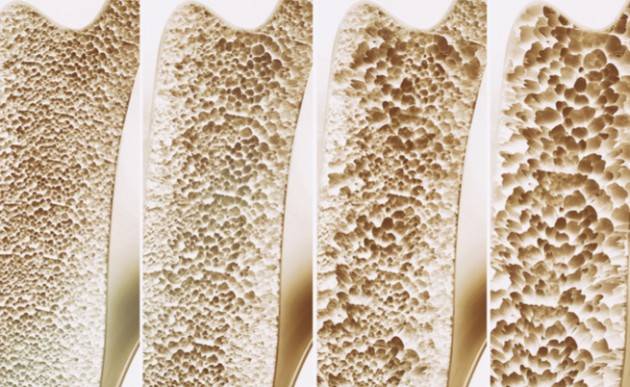 Lecco  Osteoporosi, una malattia da conoscere e da non sottovalutare