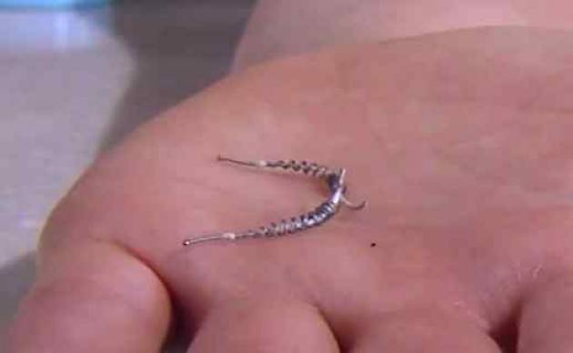 Codacons CREMONA: ESSURE, DISPOSITIVO CONTRACCETTIVO PERMANENTE SOTTO ACCUSA.