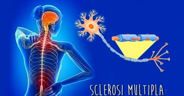 La sclerosi multipla non aumenta il rischio di ammalarsi