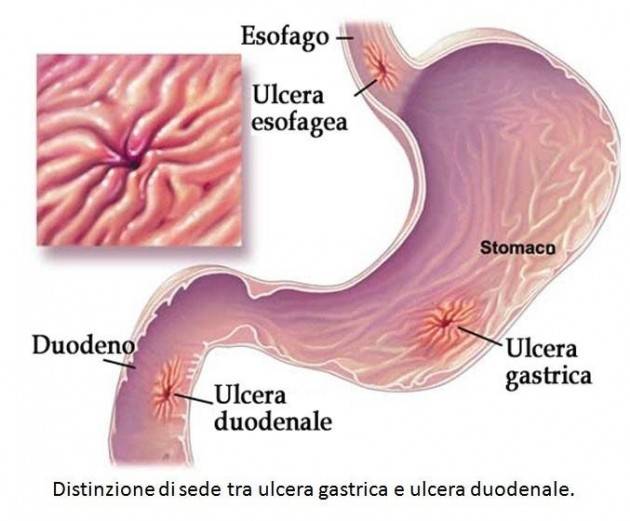 Ulcera gastrica: i sintomi iniziali e le cure suggerite