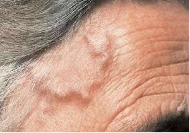 Malattia di Horton: i sintomi e la terapia per l'arterite temporale