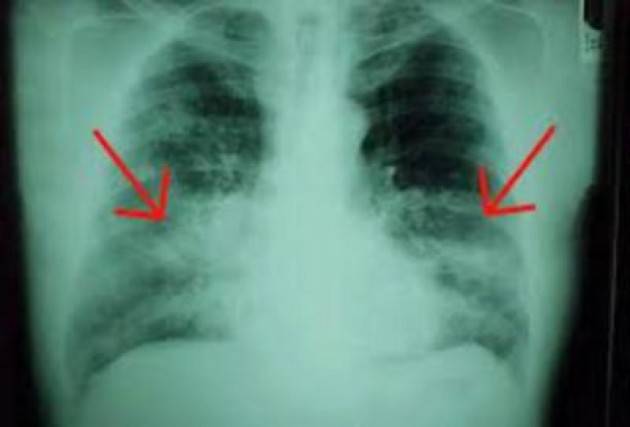 Conseguenze del Covid: fibrosi polmonare nei casi gravi, chi è a rischio?