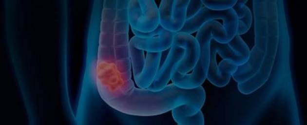 Un nanosistema per contrastare il tumore al colon