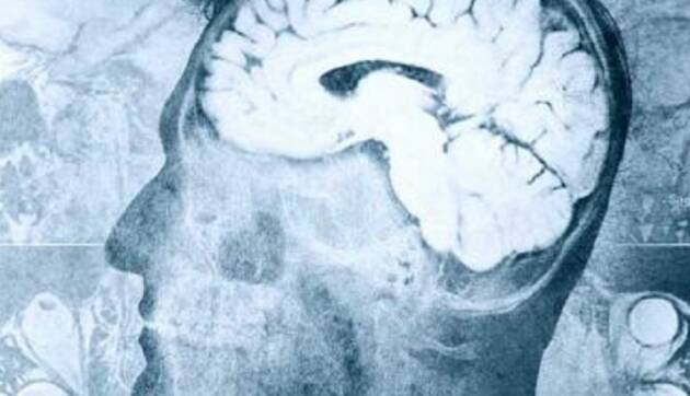 Modelli biofisici computerizzati dell’attività del cervello per predire i deficit neurologici nell'ictus