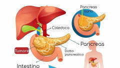 Firma Petizione AIFA i farmaci per malati di tumore al pancreas vanno rinborsati