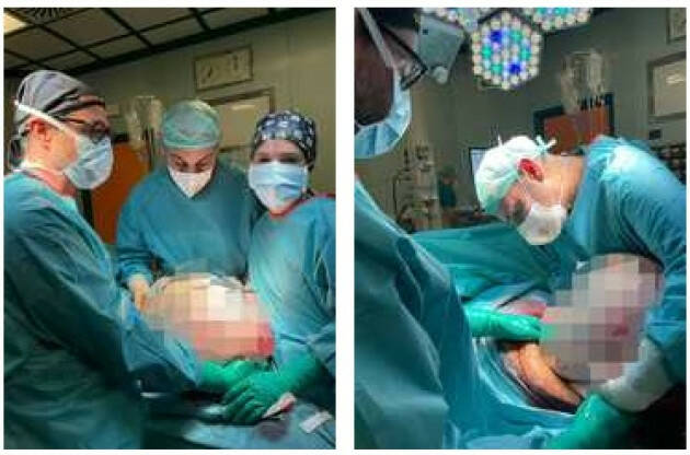 Crema Asportata una massa di 30 chili, l’intervento al Maggiore
