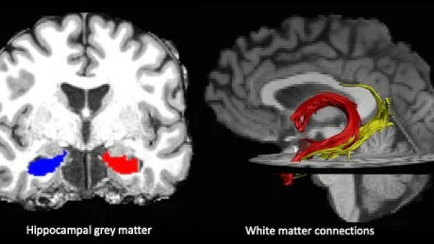 Anziani ADUC Effetti dell'età e non solo. Il cervello che si raggrinzisce