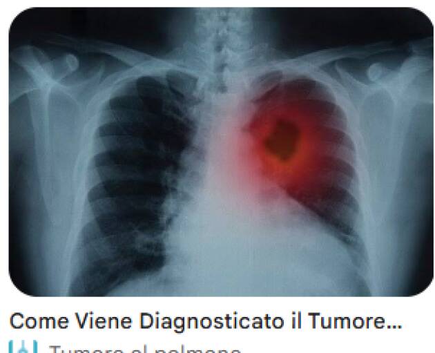 LNotizie-Tumore del polmone: al via lo screening gratuito