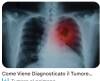 LNotizie-Tumore del polmone: al via lo screening gratuito 