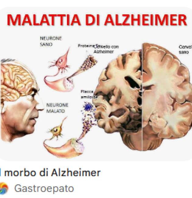 ADUC Roma Morbo di Alzheimer: chi paga la retta della RSA?